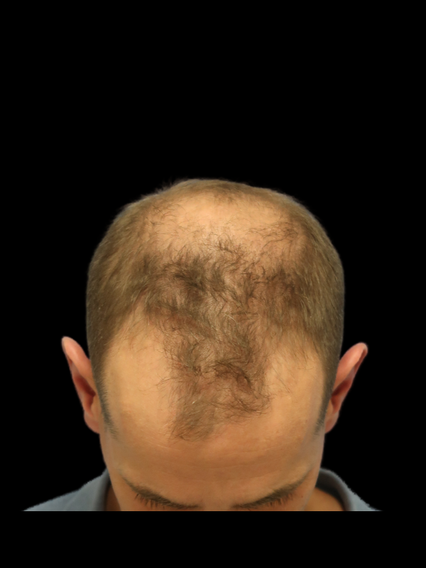 Hair Loss Restoration Before & After