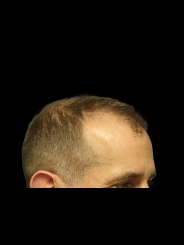 Hair Loss Restoration Before & After