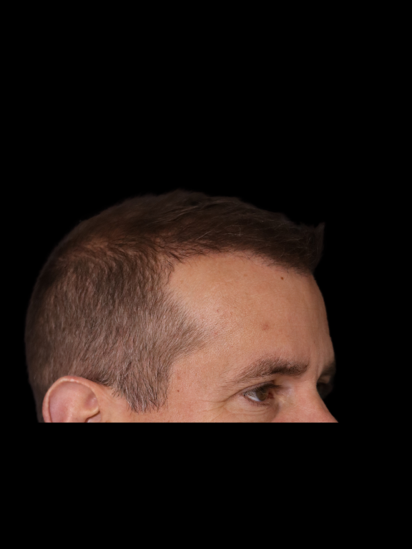 Hair Loss Restoration Before & After