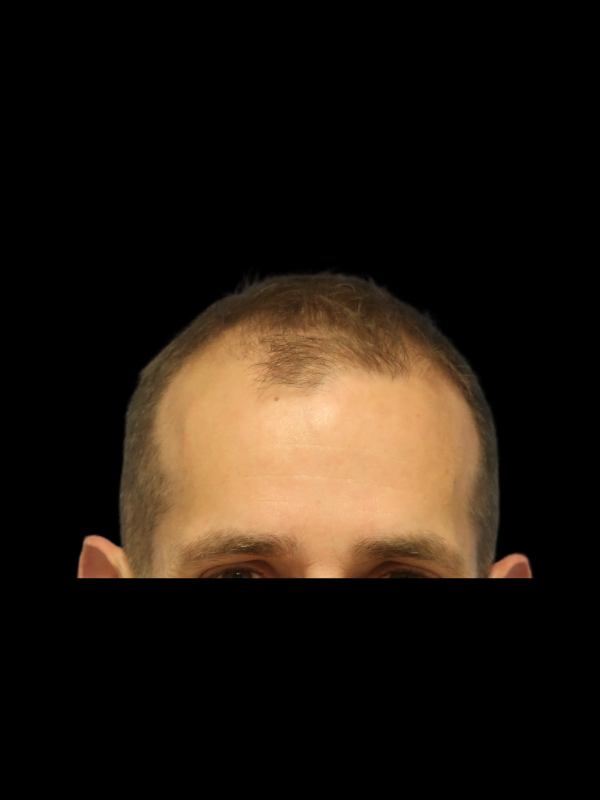Hair Loss Restoration Before & After