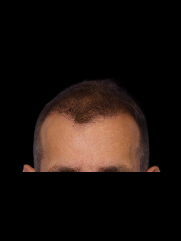 Hair Loss Restoration Before & After