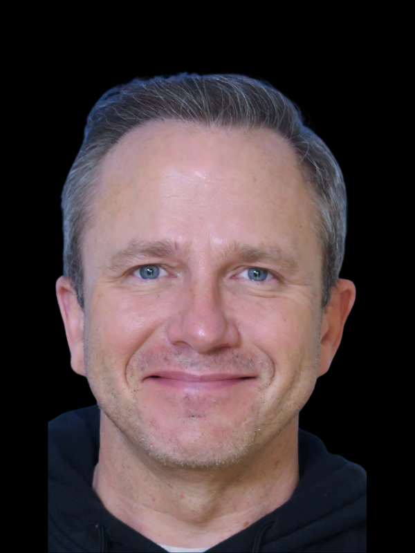 Hair Loss Restoration Before & After