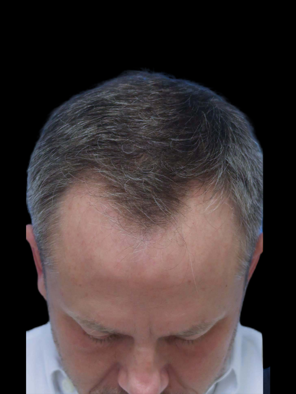 Hair Loss Restoration Before & After