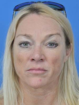 Facial Fat Grafting Before & After