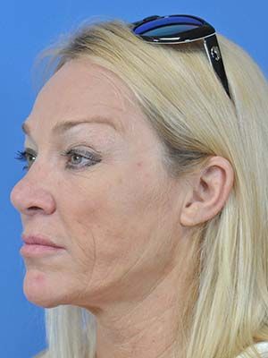 Facial Fat Grafting Before & After