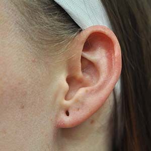 Earlobe Repair Before & After