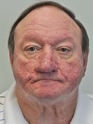 Rosacea And Rhinophyma Before & After