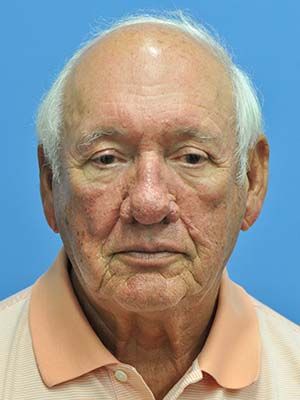 Rosacea And Rhinophyma Before & After