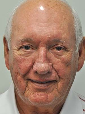 Rosacea And Rhinophyma Before & After