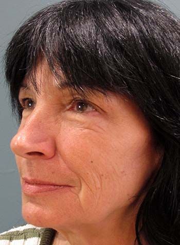 Botox Before & After