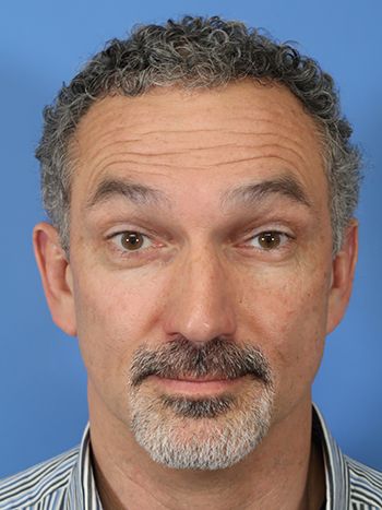 Botox Before & After