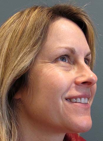 Botox Before & After