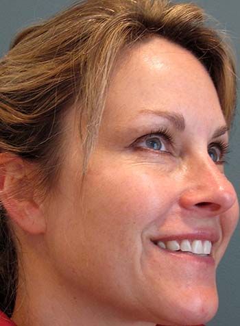 Botox Before & After