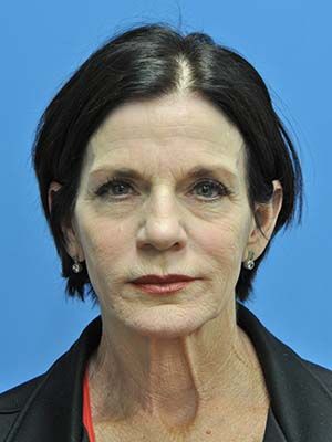 Laser Resurfacing Before & After