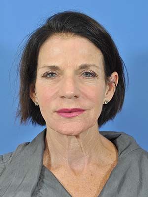 Laser Resurfacing Before & After