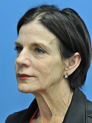 Laser Resurfacing Before & After