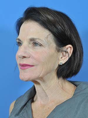 Laser Resurfacing Before & After