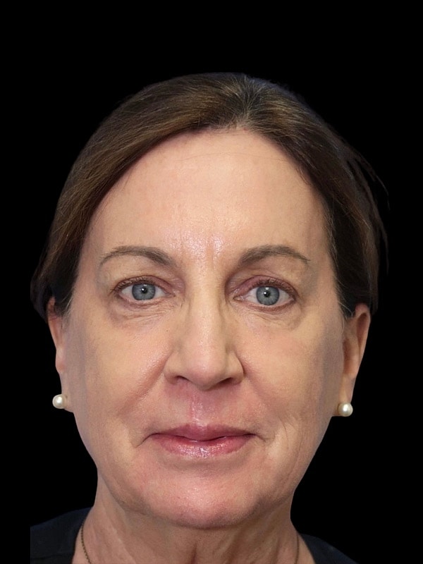 Laser Resurfacing Before & After