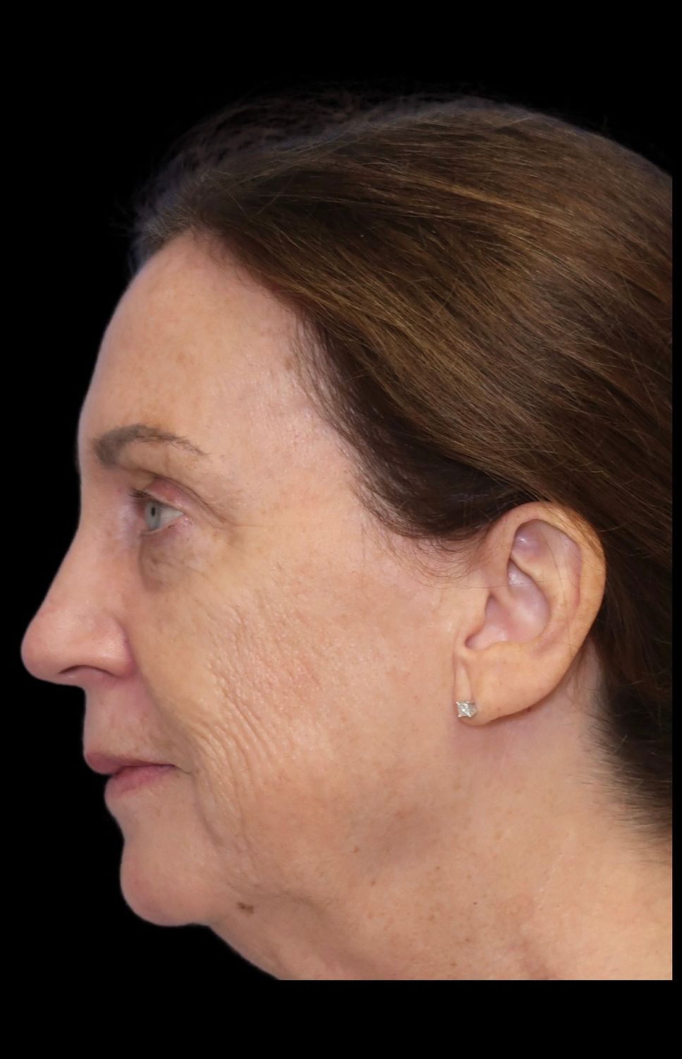 Laser Resurfacing Before & After 