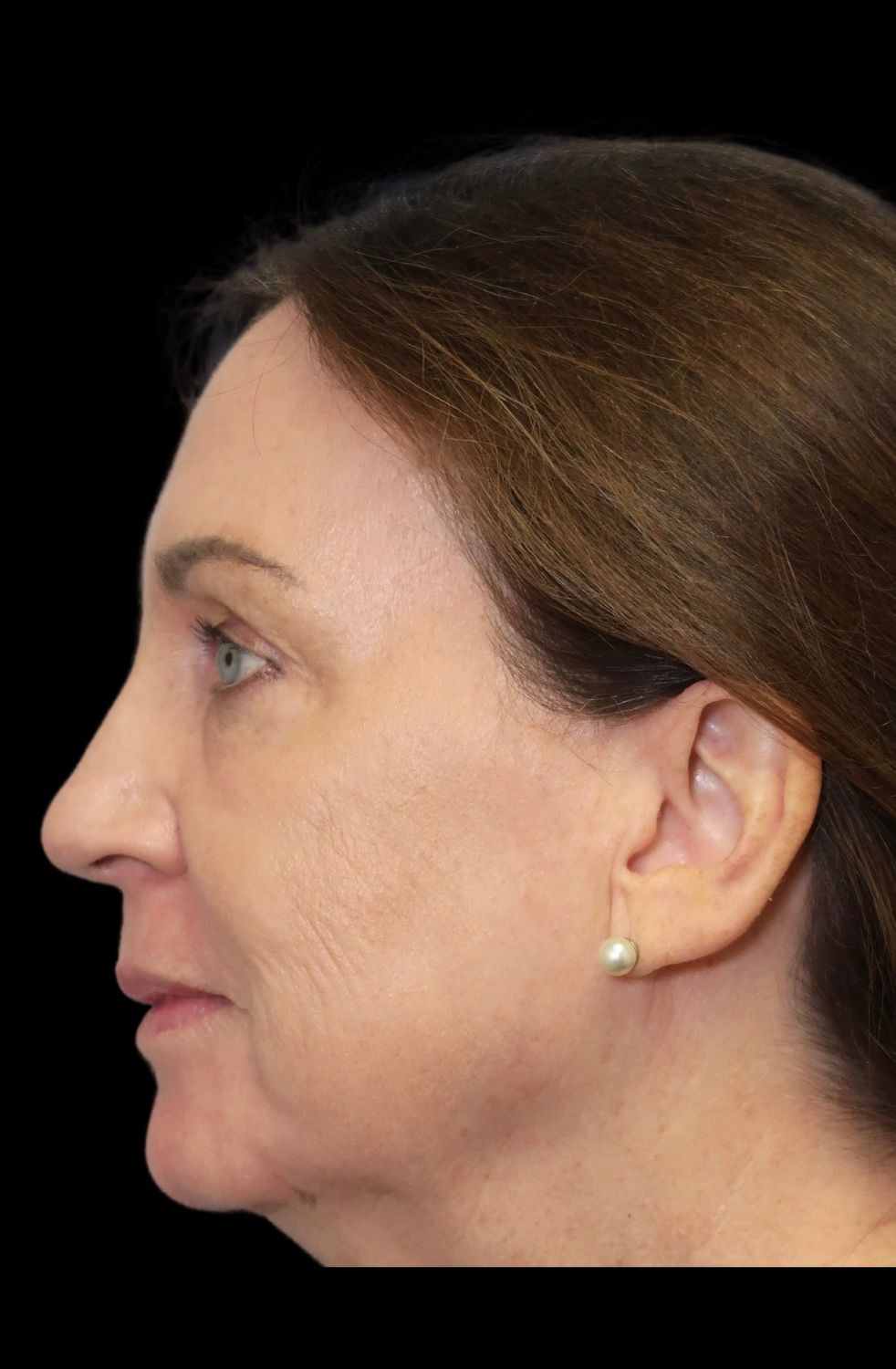 Laser Resurfacing Before & After