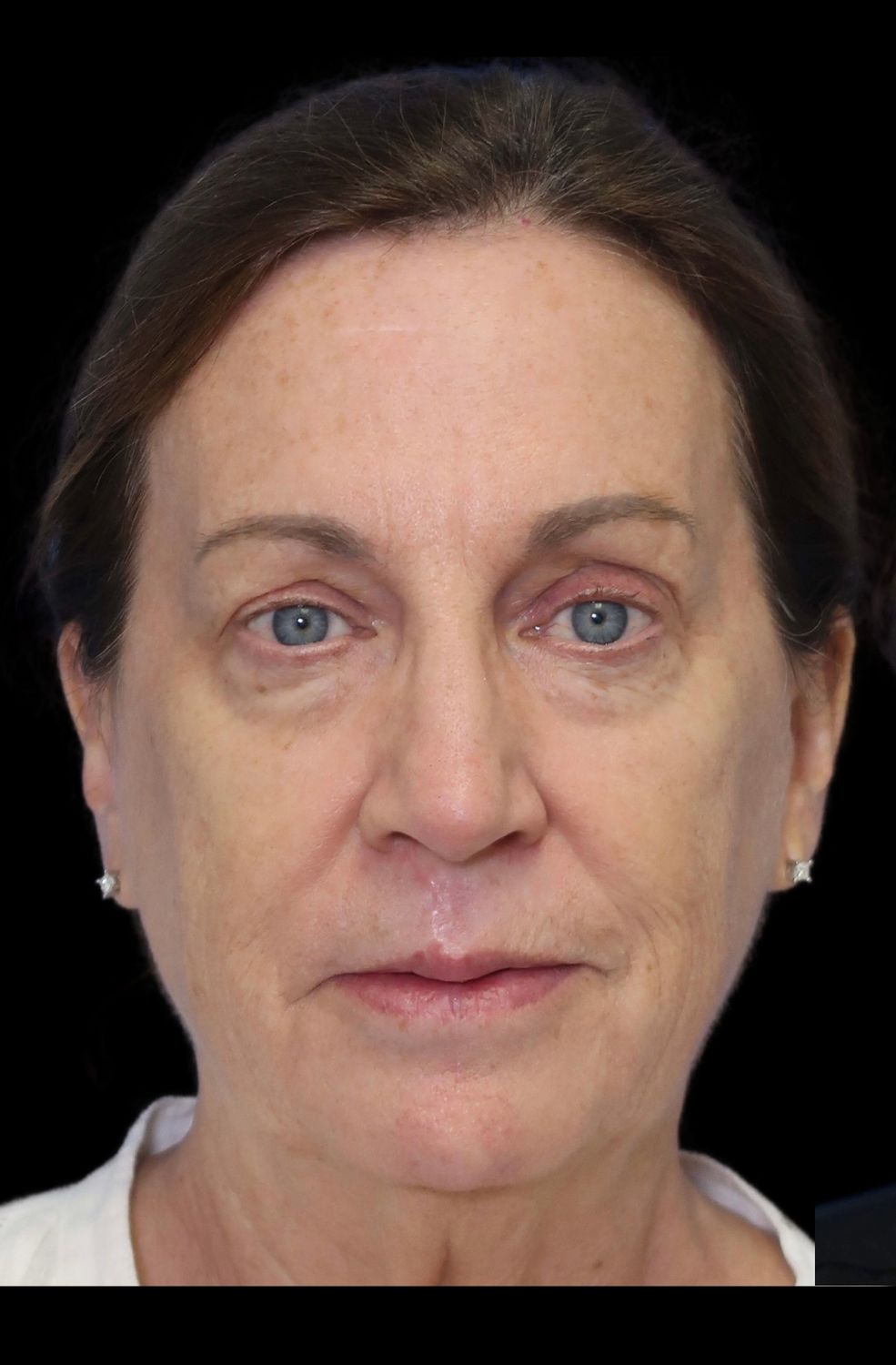 Laser Resurfacing Before & After