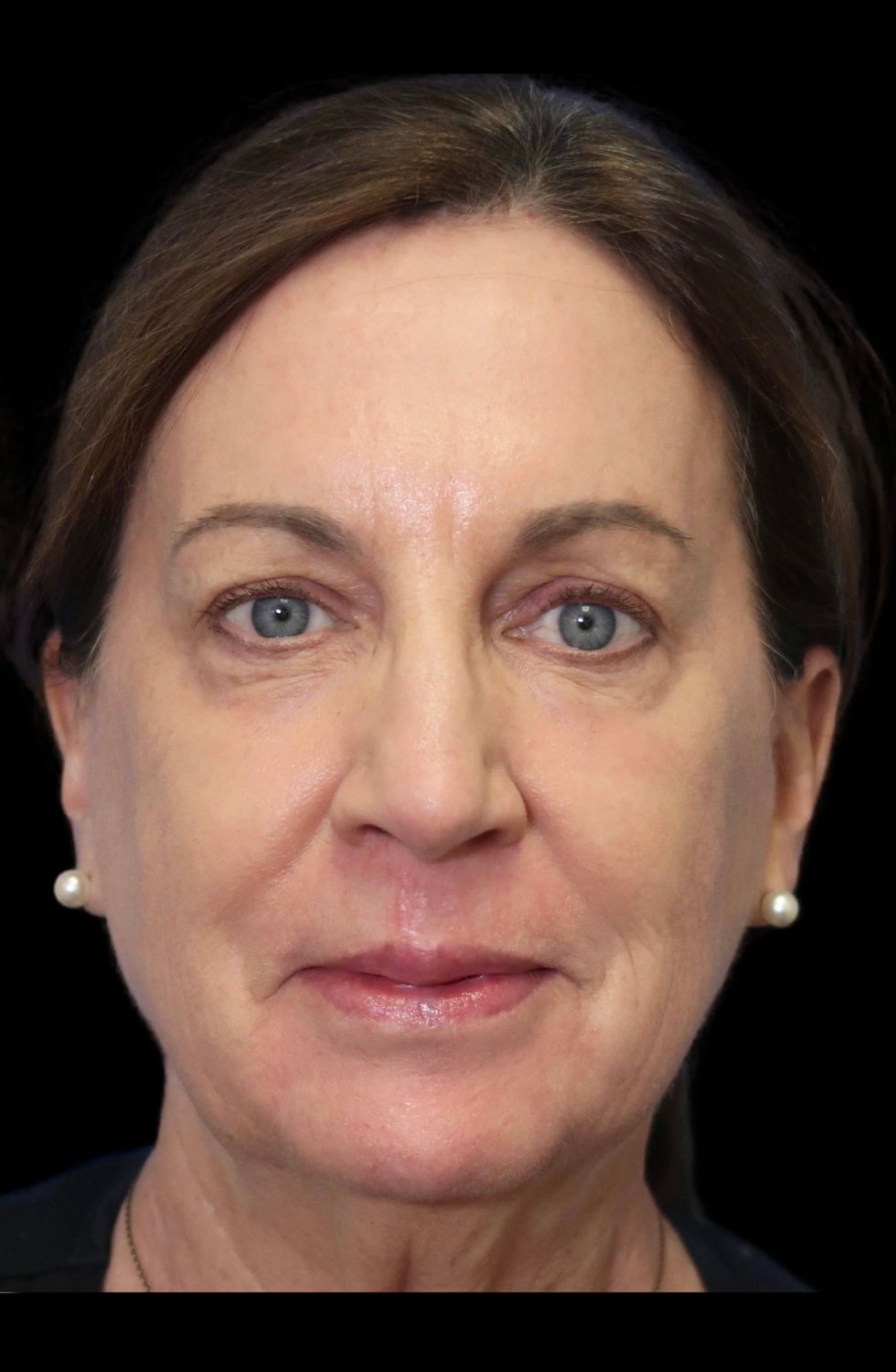 Laser Resurfacing Before & After