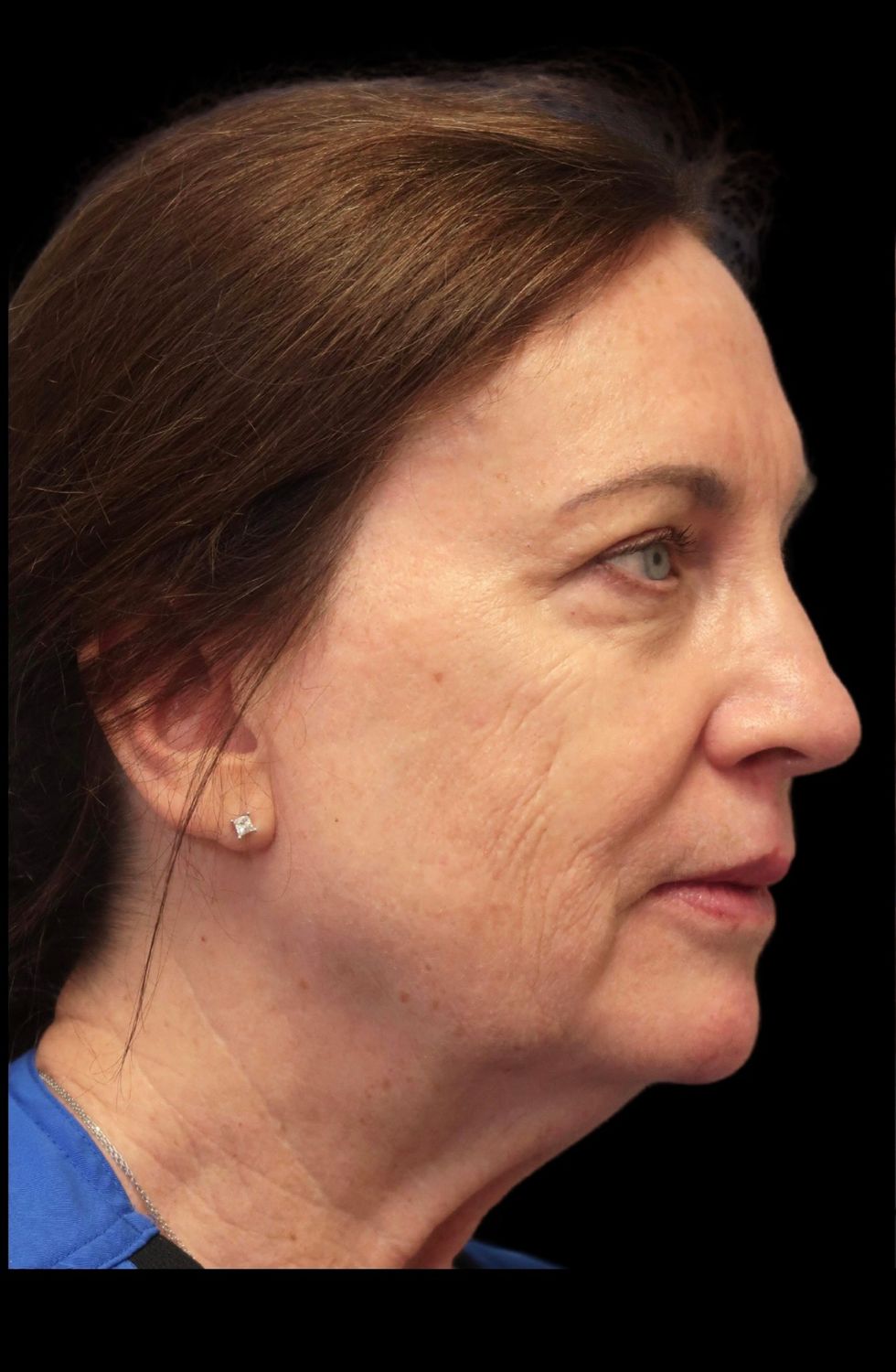 Laser Resurfacing Before & After