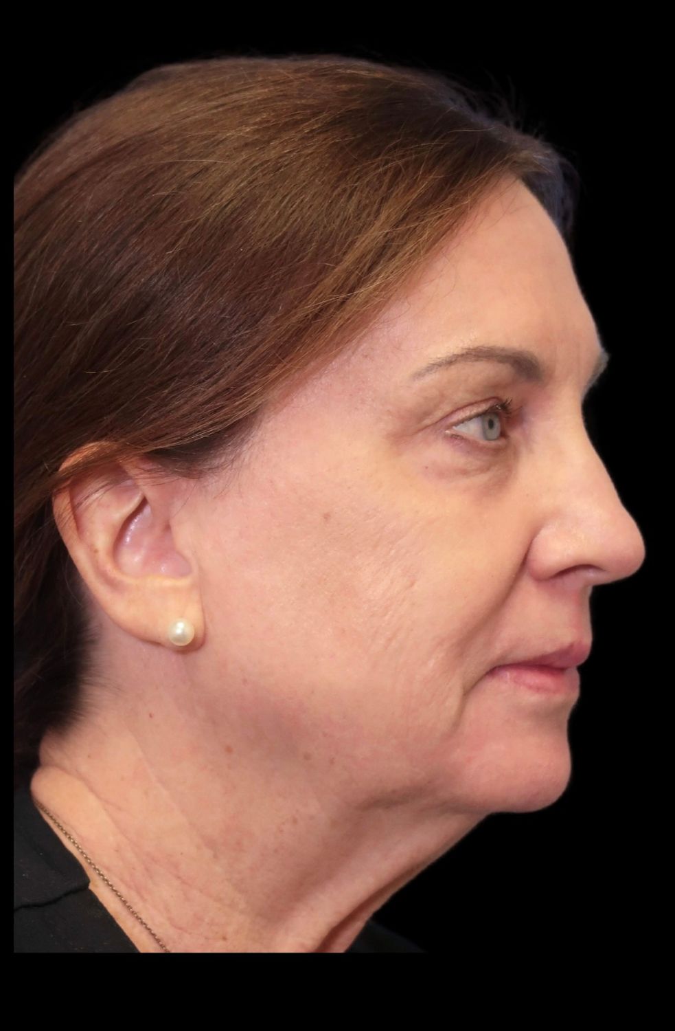 Laser Resurfacing Before & After