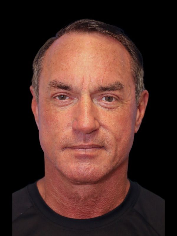 Deep Necklift Before & After