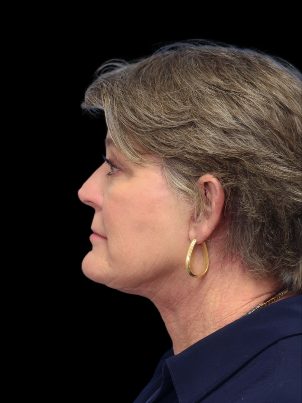 Deep Necklift Before & After