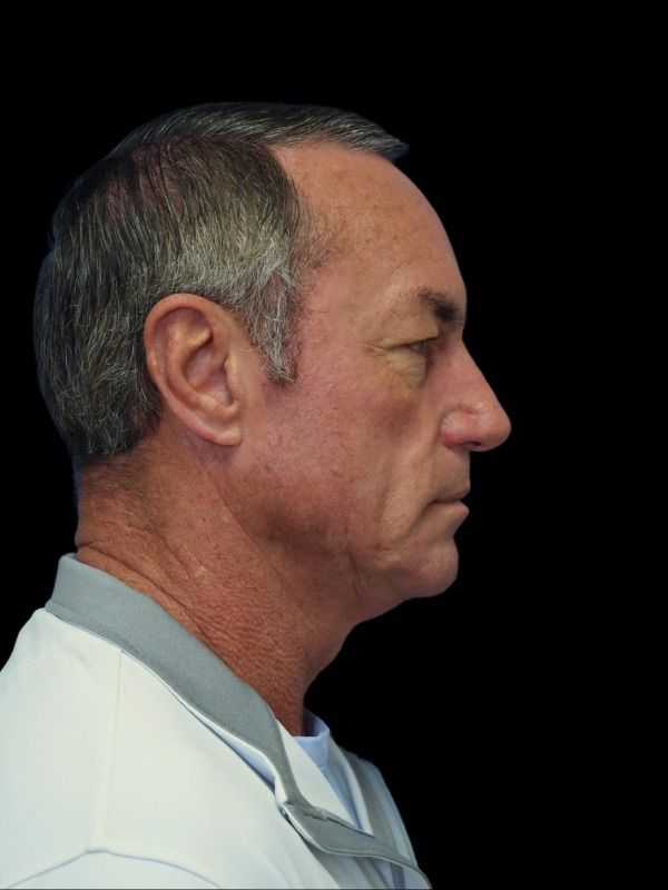 Deep Necklift Before & After