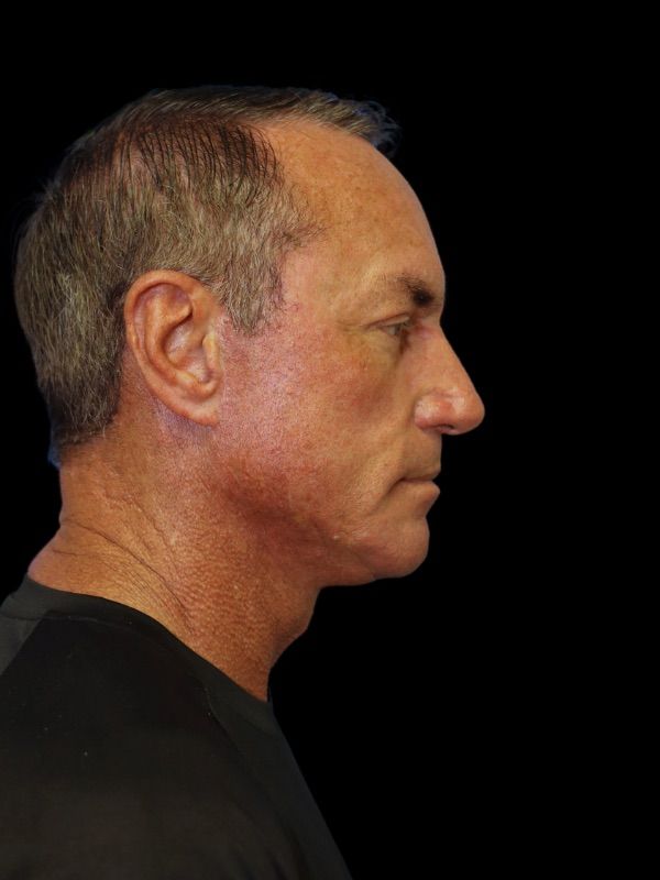 Deep Necklift Before & After