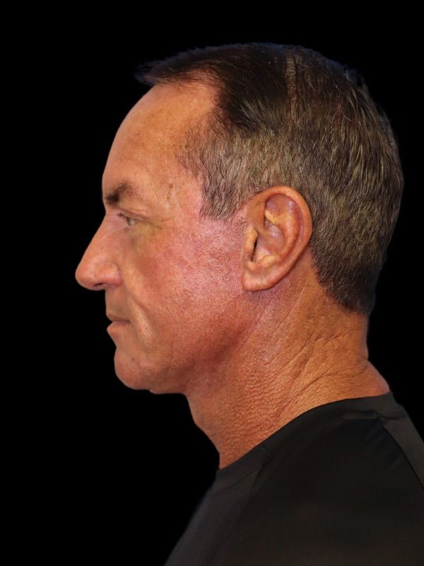 Deep Necklift Before & After