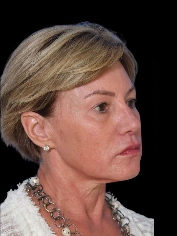 Deep Necklift Before & After