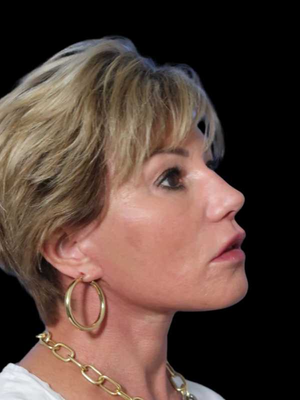 Deep Necklift Before & After