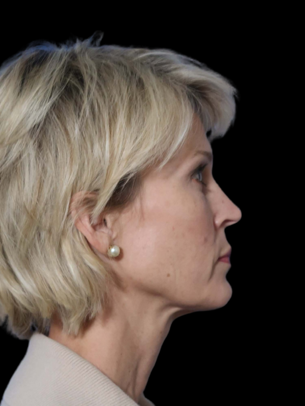 Deep Necklift Before & After