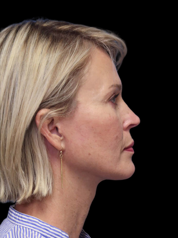Deep Necklift Before & After