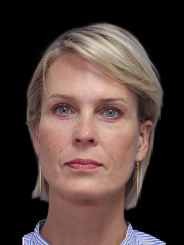 Deep Necklift Before & After