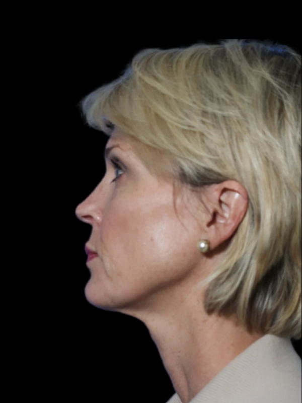 Deep Necklift Before & After