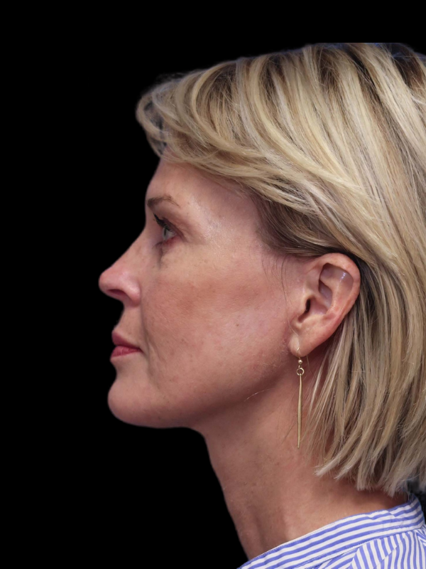 Deep Necklift Before & After