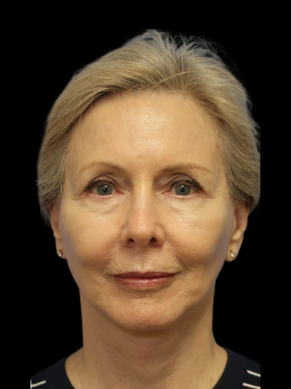 Deep Necklift Before & After