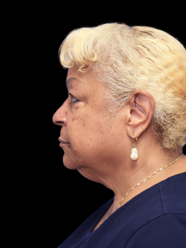 Deep Necklift Before & After