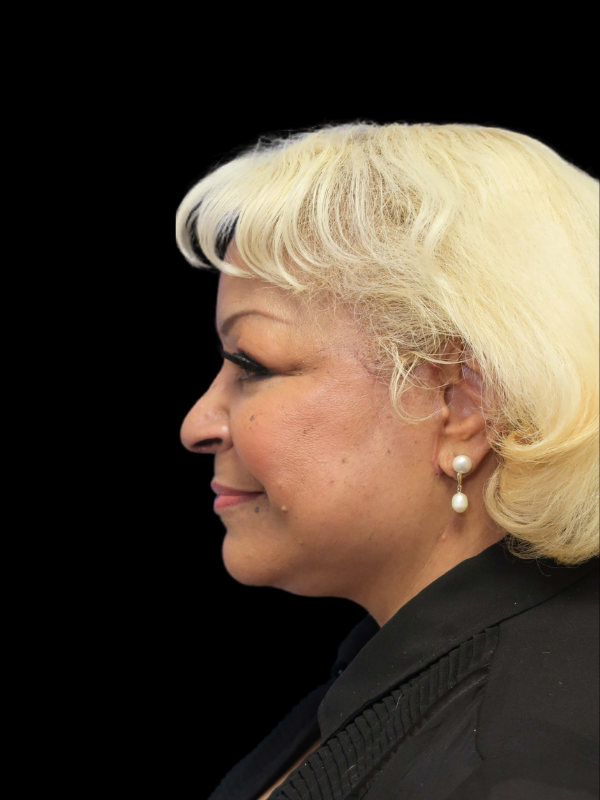 Deep Necklift Before & After