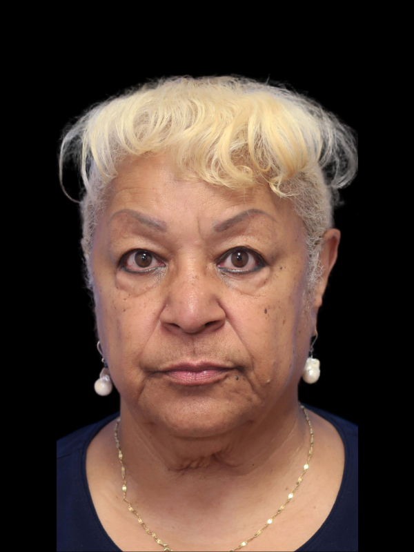 Deep Necklift Before & After