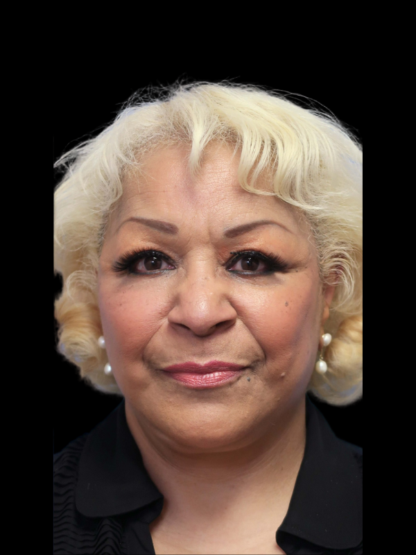 Deep Necklift Before & After