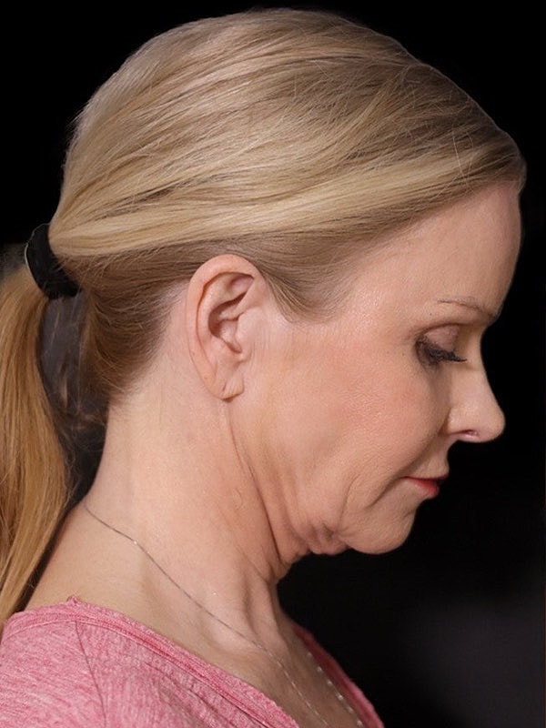 Deep Necklift Before & After