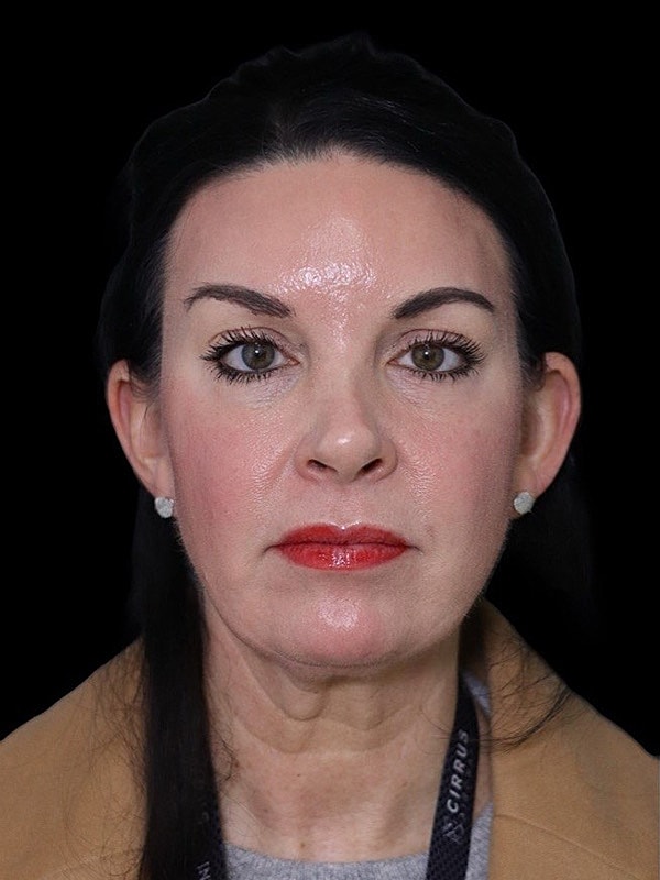 Deep Necklift Before & After