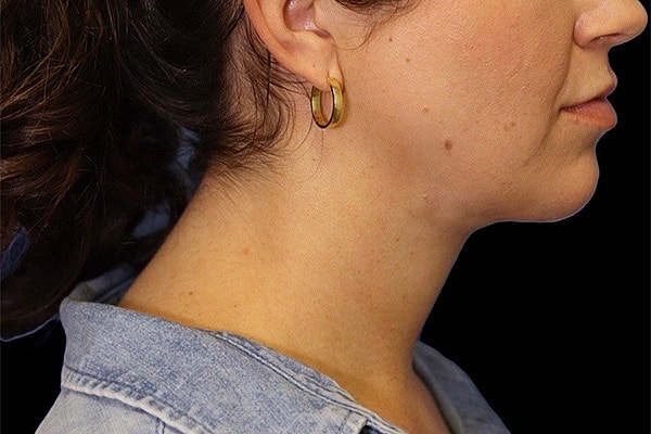 Deep Necklift Before & After