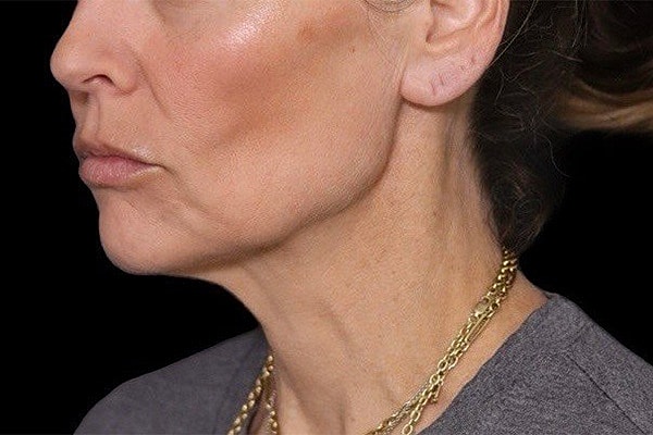 Deep Necklift Before & After