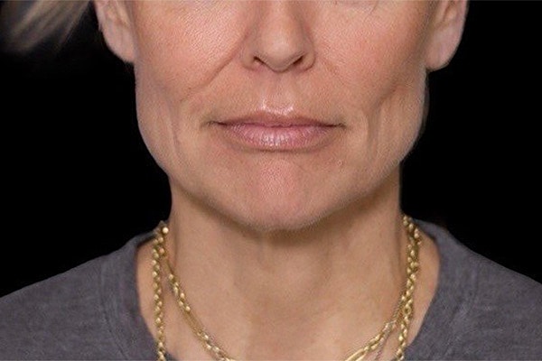 Deep Necklift Before & After
